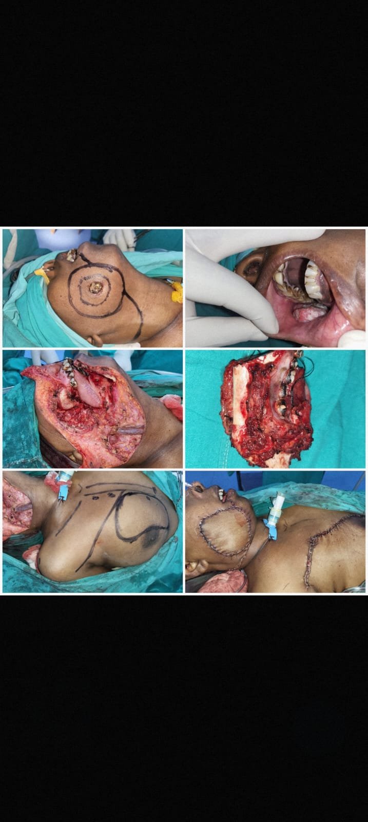 oral cancer